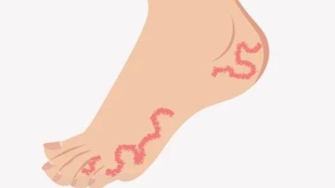 La desagradable larva migratoria que sufre Lucía Pombo: crece y se mueve bajo la piel