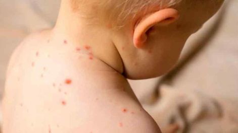 Sarampión, ya son 48 los casos en Argentina (Archivo).