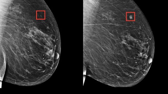 Se trata de una serie de algoritmos que aprenden los sutiles patrones del tejido mamario que son precursores de un tumor maligno. Foto: Massachusetts General Hospital.