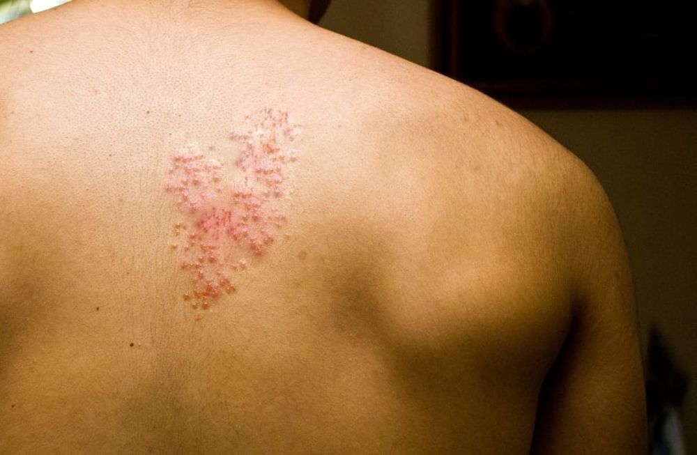 Herpes Zóster: ¿qué tenemos que saber sobre la enfermedad?