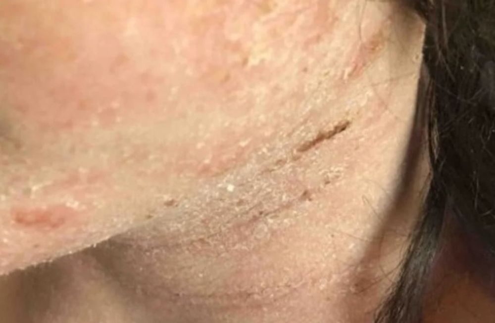 A Barney Rae (14) le diagnosticaron el año pasado un eczema gravísimo.