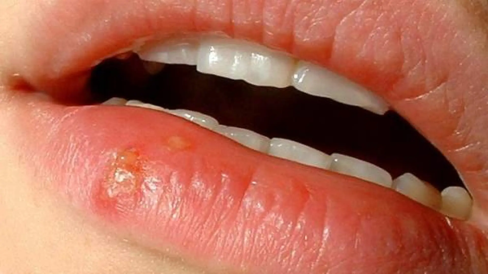 Herpes labial: cómo se transmite y qué tratamientos recomiendan los ...