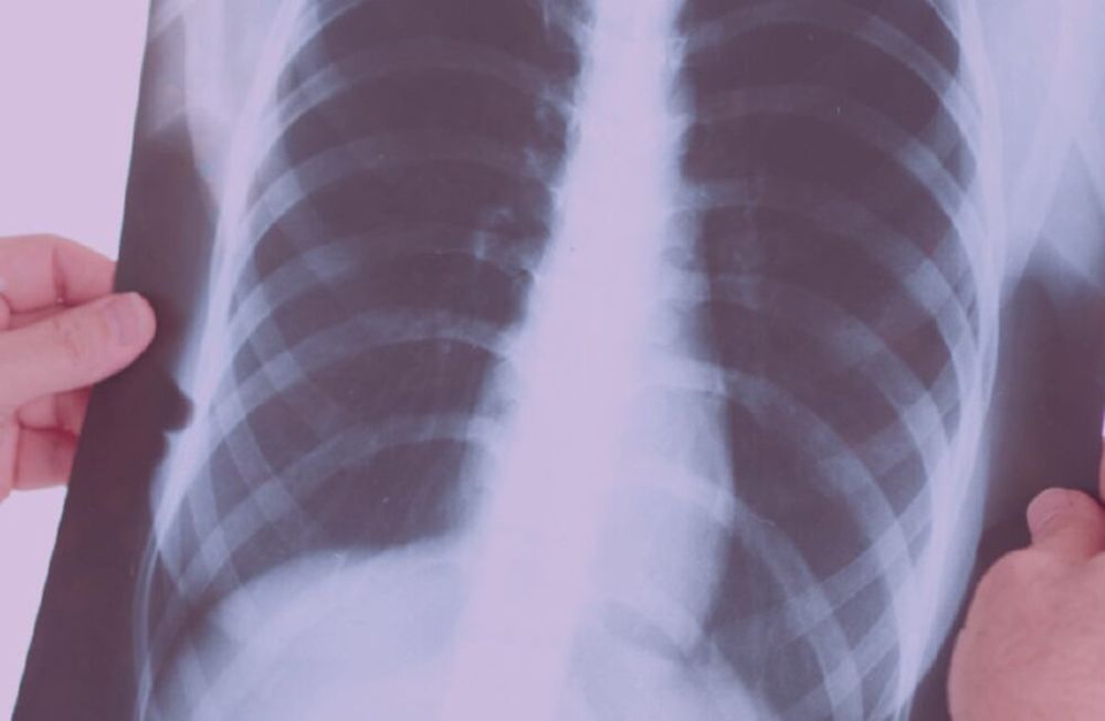 ¿Qué se entiende por neumonía?