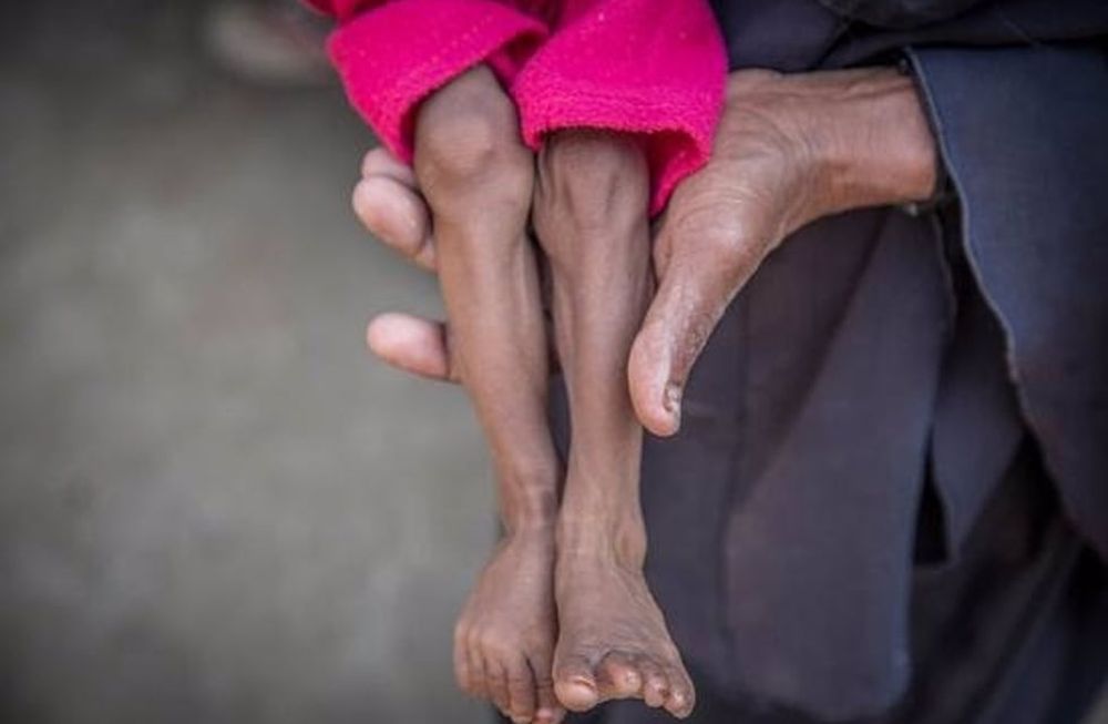 21/11/2018 Un niño con desnutrición.La organización no gubernamental Save the Children ha denunciado este miércoles que cerca de 85.000 niños menores de cinco años podrían haber muerto por inanición desde abril de 2015 en Yemen como consecuencia de la guerra que está viviendo el país.POLITICA ORIENTE PRÓXIMO ASIA INTERNACIONAL YEMENSAVE THE CHILDREN