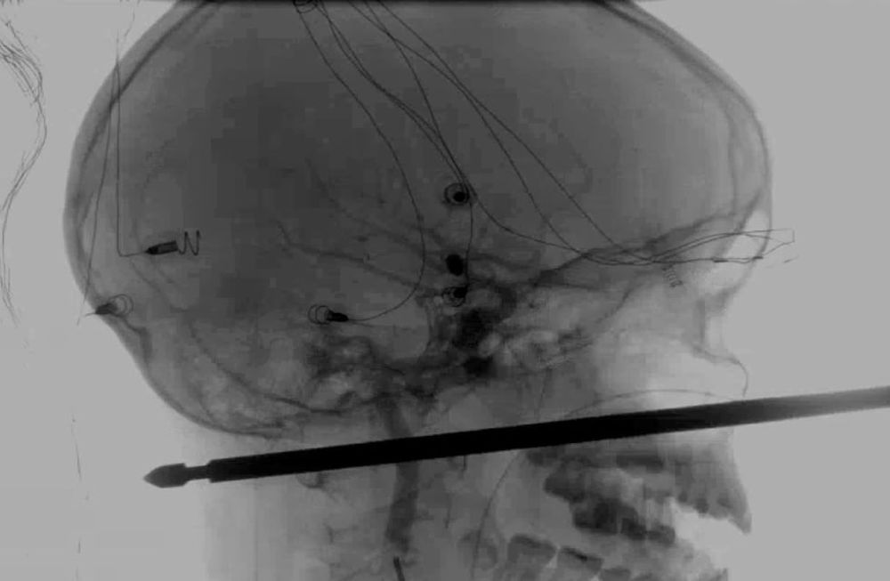 Impresionante: un niño cayó de un árbol, un hierro le atravesó el cráneo y sobrevivió