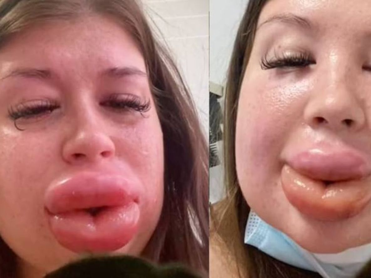 Una joven se inyectó ácido hialurónico en los labios “para ser hermosa” y terminó internada. / Foto: gentileza