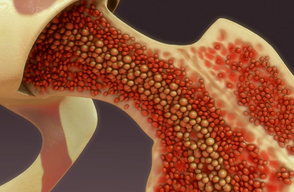 ¿Cómo puedo ser donante de médula ósea?