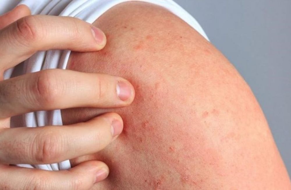 ¿Sabías que se estima que 1 de cada 10 argentinos tienen dermatitis atópica?