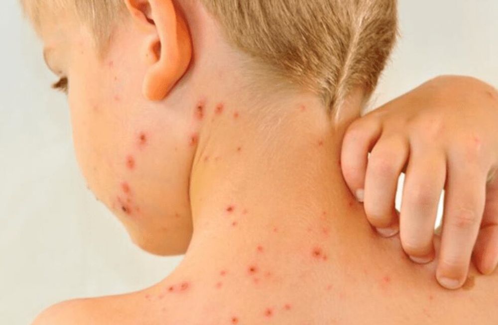 El sarampión es una enfermedad viral caracterizada por fiebre alta, tos, congestión nasal, exantema, ojos llorosos o enrojecidos, y posibilidad de manchas blancas en la cara interna de las mejillas, entre otros síntomas. De todos modos, Salud recuerda que, en personas con antecedente de vacunación, la presentación sintomática no siempre toma esta forma típica.