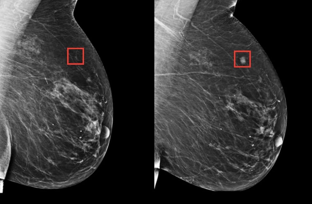 Se trata de una serie de algoritmos que aprenden los sutiles patrones del tejido mamario que son precursores de un tumor maligno. Foto: Massachusetts General Hospital.