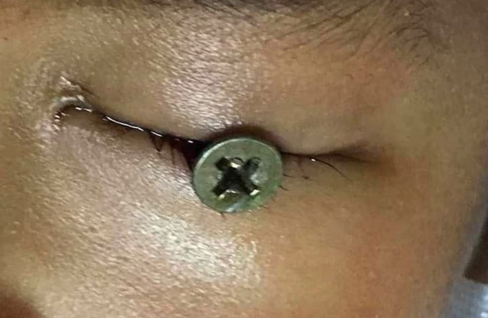 Un nene de 3 años sufrió una terrible lesión ocular cuando su papá cortaba el pasto y un tornillo se engancó en la máquina, voló y se clavó en su ojo.