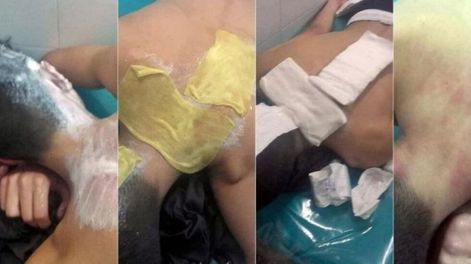 En La Pampa un hincha quemó con agua caliente a un futbolista de 15 años