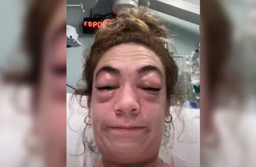 Una tiktoker mostró la reacción alérgica que tuvo tras ponerse una extensión de pestañas.
