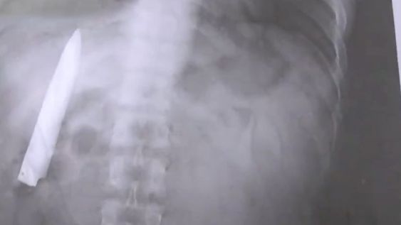 Un hombre filipino de 25 años se realizó algunas pruebas médicas y descubrió que lleva un cuchillo en su interior. Foto: Captura de Video