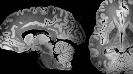 En comparación con muestras de 2016, las de 2024 contenían un 50% más de partículas, sumando aproximadamente 4,800 microgramos de microplásticos por gramo de tejido cerebral.