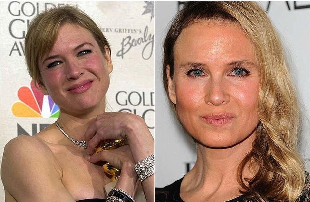 Renée Zellweger cometió un ‘suicidio facial’