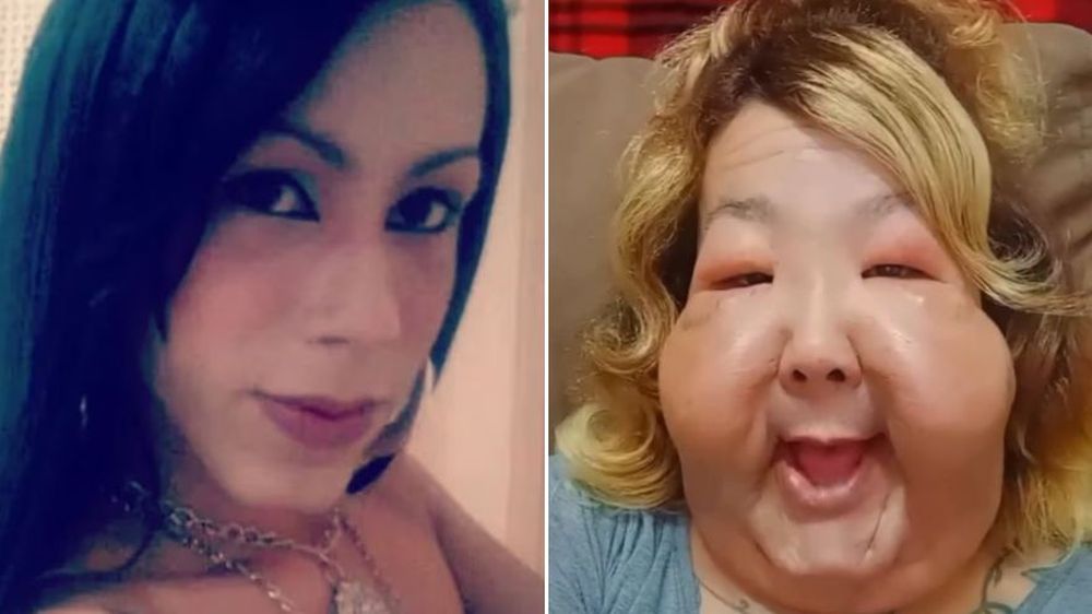 Una influencer de Brasil se sometió a una cirugía estética clandestina que dejó una deformación en su rostro.&nbsp;