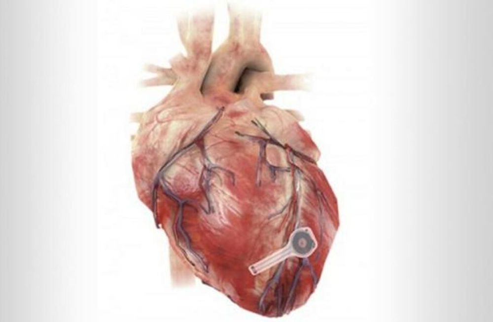 El nuevo marcapaso es biodegradable y no necesita intervención quirúrgica para su colocación. además se disuelve cuando el corazón ya no lo necesita.