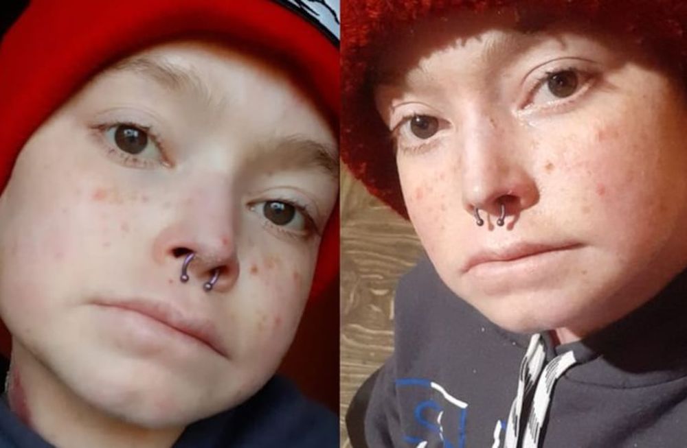 Anahí Vázquez, tiene 31 años y padece de piel de cristal. Necesita viajar a Turquía para realizarse una operación y no perder sus manos. (Foto: gentileza TN)