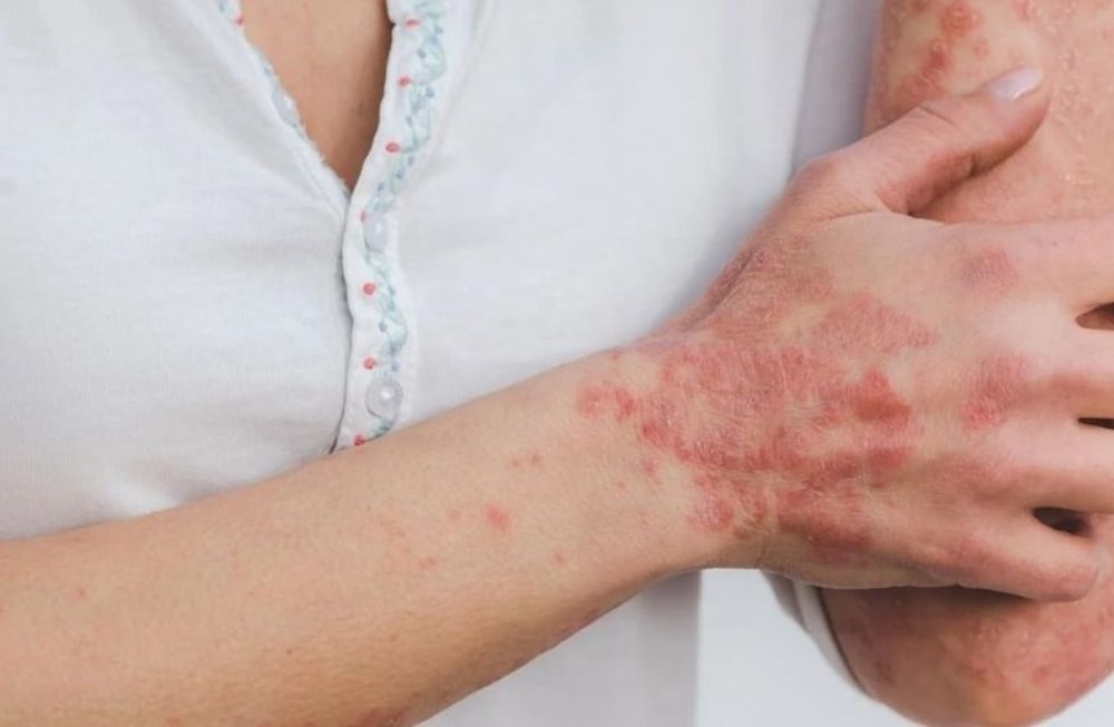 Te revelamos los mitos y realidades en torno a la psoriasis