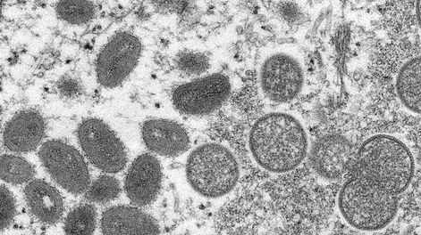 Esta imagen de microscopio electrónico de 2003 proporcionada por los Centros para el Control y la Prevención de Enfermedades muestra viriones maduros de viruela del mono de forma ovalada, a la izquierda, y viriones inmaduros esféricos, a la derecha, obtenidos de una muestra de piel humana (AP)