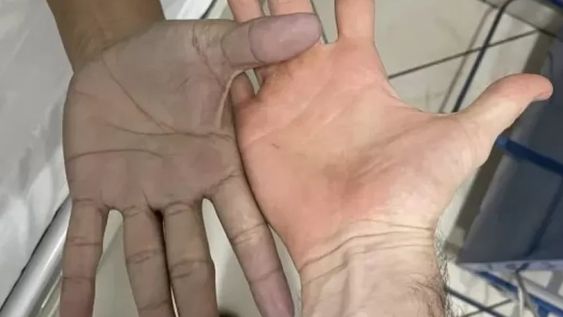 El médico que lo atendió escribió en Twitter: “Paciente joven acude por coloración azulada de manos, sin ninguna enfermedad de base. Gentileza: La Gaceta.
