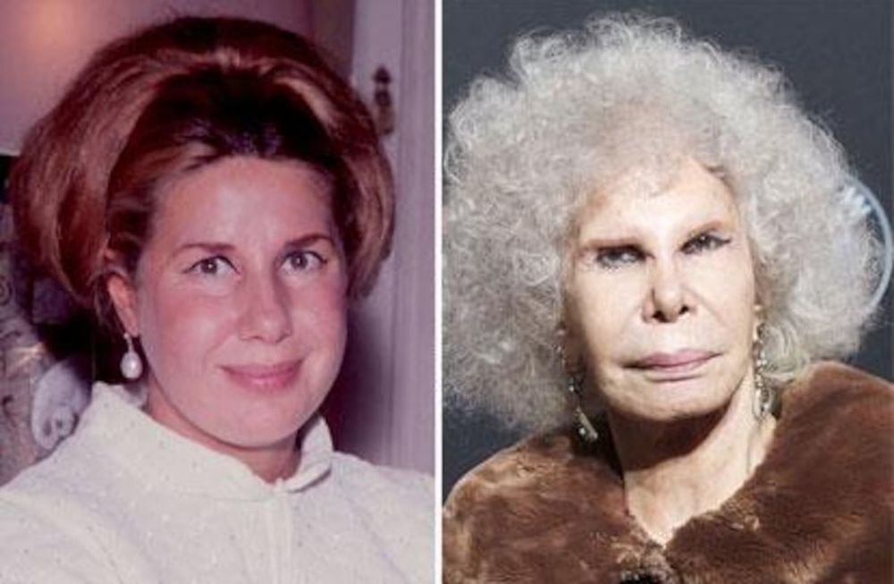 Diez cirugías plásticas de famosos que no salieron bien