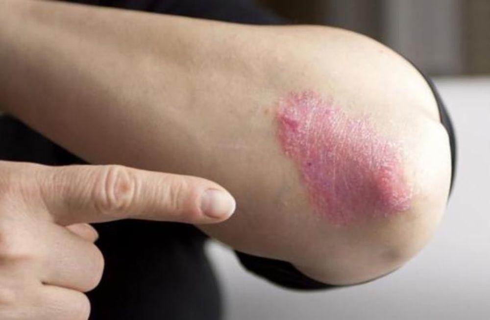 Psoriasis: educación y nuevos tratamientos, el camino para el  control de la enfermedad