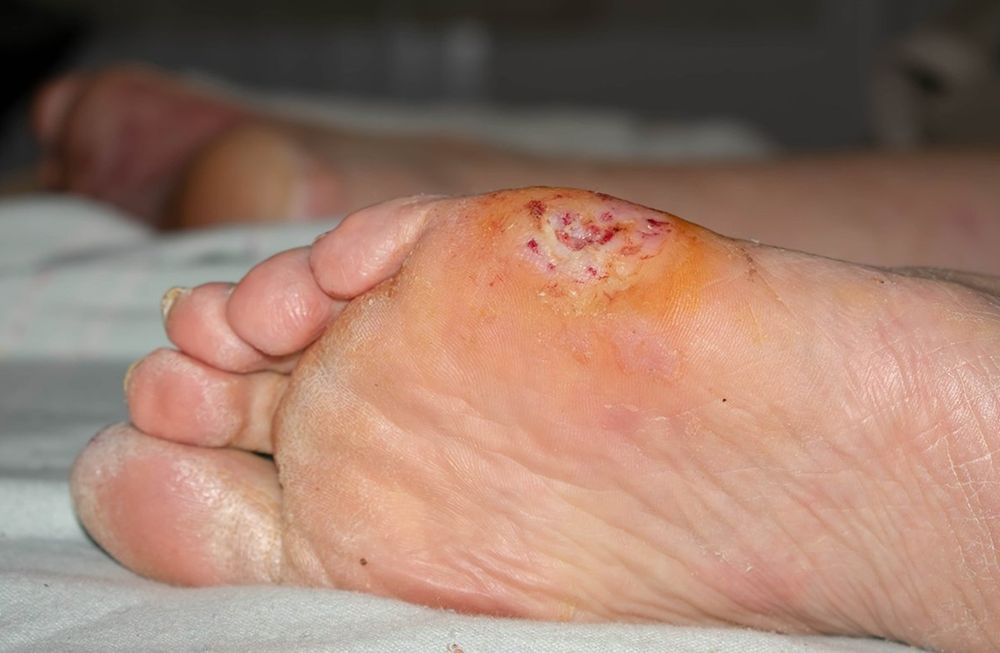 Estos problemas pueden hacer que se vuelvan menos sensibles a lesiones y, si no se cuidan adecuadamente, pueden generar infecciones graves.