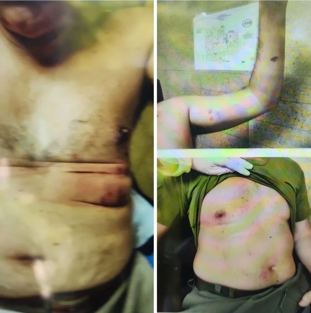 Las hematomas en el torso, la zona abdominal y la cara interna del brazo del ex Comandante Mayor Diego Gasparutti