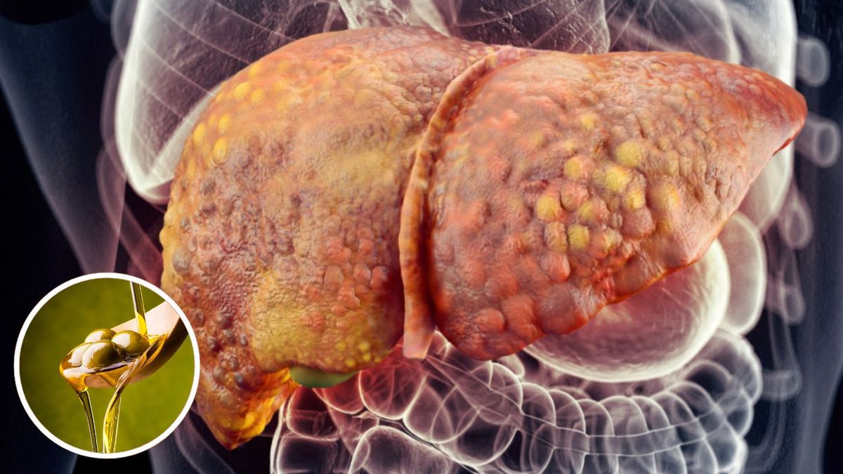 Una investigación evalúa tratar la enfermedad del hígado graso con aceite de oliva