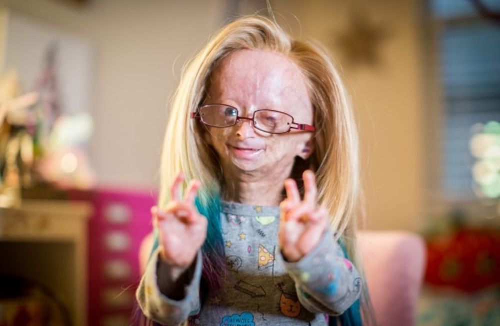 Adalia Rose, la joven con envejecimiento prematura que falleció hace algunas horas.