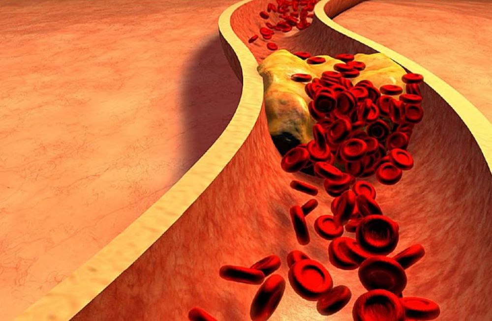 El colesterol elevado puede afectar la salud, en particular la salud cardiovascular, sin embargo, los hábitos de vida y sobre todo alimentarios de una buena proporción de la población son perjudiciales en este sentido. / Sanatorio Allende