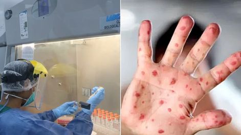 La OMS tomó la iniciativa de cambiar el nombre de la viruela del mono. Foto: Web