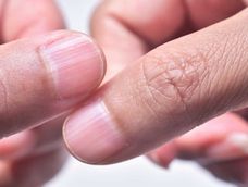 que significa tener las unas con rayas, segun la ciencia