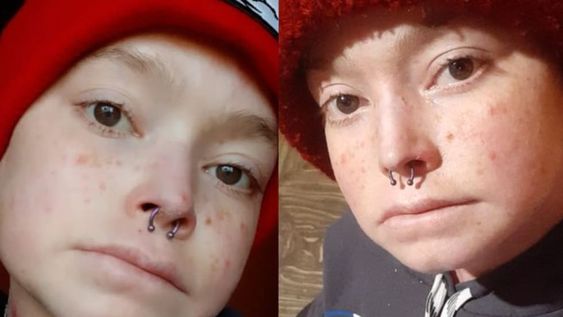 Anahí Vázquez, tiene 31 años y padece de piel de cristal. Necesita viajar a Turquía para realizarse una operación y no perder sus manos. (Foto: gentileza TN)