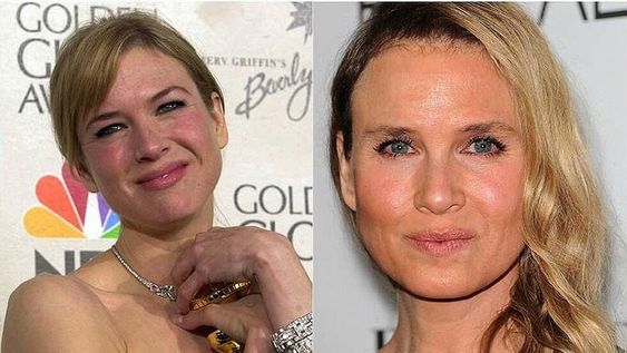 Renée Zellweger cometió un ‘suicidio facial’