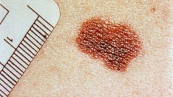 “Te damos las claves para protegerte del daño solar”