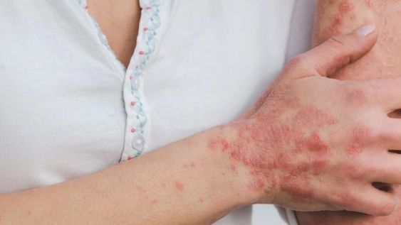 Te revelamos los mitos y realidades en torno a la psoriasis