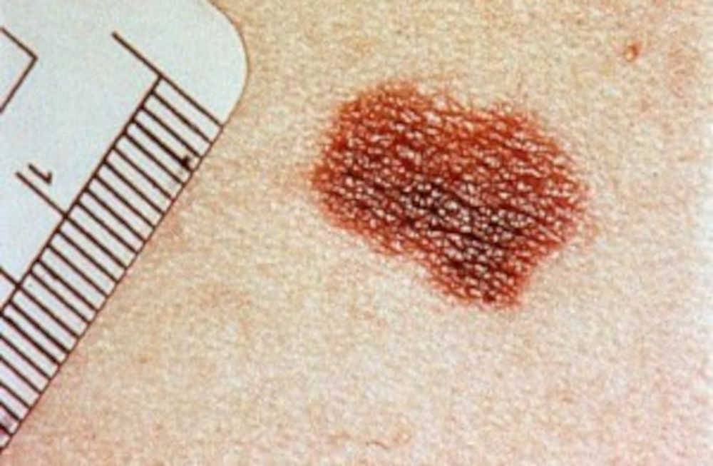 “Te damos las claves para protegerte del daño solar”