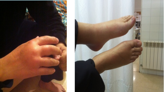 .Que es el angioedema hereditario, una enfermedad rara que impacta en la calidad de vida Se realizó un esclarecedor estudio en Argentina que concluyó que afecta aspectos físicos, mentales, emocionales y sociales de los pacientes