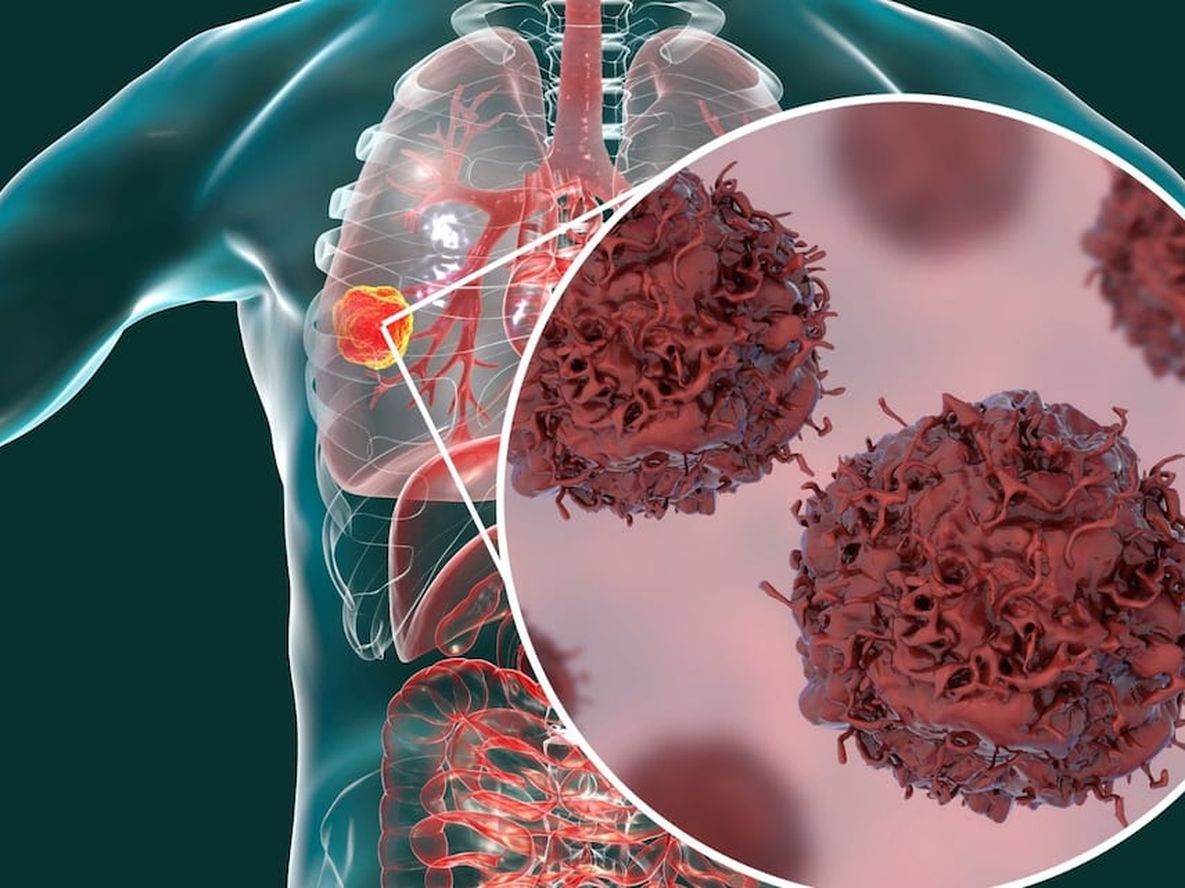 El cáncer de pulmón, el tipo de cáncer más prevalente y uno de los más agresivos