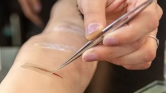 Un apósito inteligente para cicatrizar las heridas crónicas