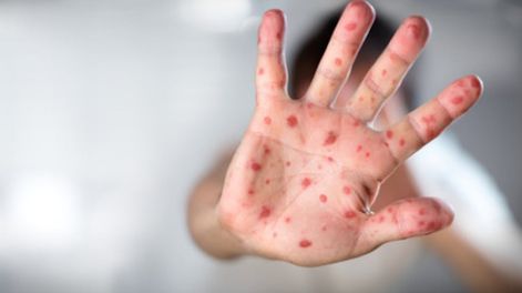 Alerta en Entre Ríos por posible exposición de pasajeros al sarampión.