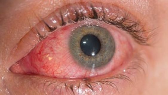 La conjuntivitis puede ser otro síntoma de COVID-19