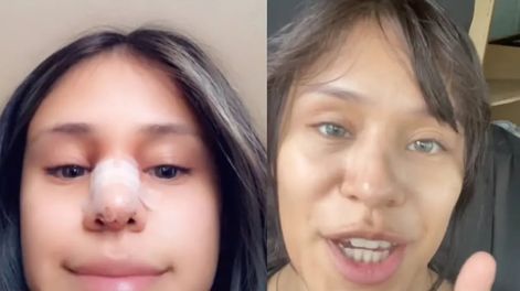 Una chica le perdonó la infidelidad a su novio a cambio de que le pague la cirugía de nariz.