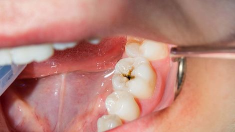 ¿Adiós a las caries? Científicos acaban de descubrir una forma de regenerar el esmalte dental