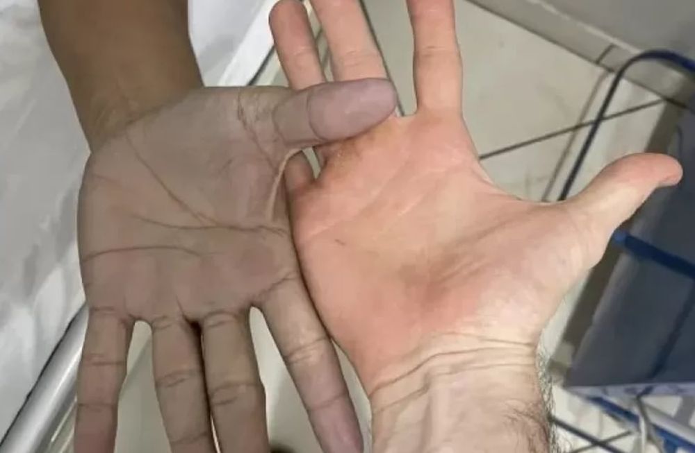 El médico que lo atendió escribió en Twitter: “Paciente joven acude por coloración azulada de manos, sin ninguna enfermedad de base. Gentileza: La Gaceta.
