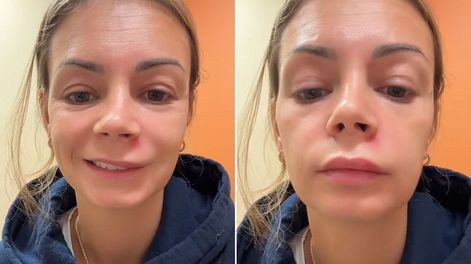 El video de una joven estadounidense que generó conciencia sobre los riesgos de reventarse un grano en la piel en el llamado “triángulo de la muerte”.