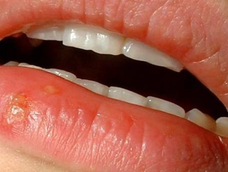 Herpes labial
